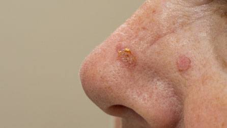 Actinic-Keratosis-img