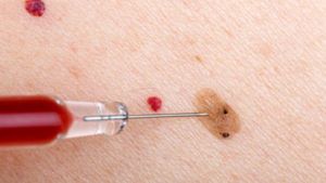 how-mobile-skin-exams-work-when-removing-a-mole-in-phoenix-az