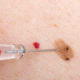 how-mobile-skin-exams-work-when-removing-a-mole-in-phoenix-az