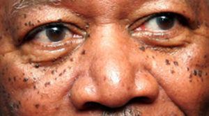 Dermatosis Papulosa Nigra (DPN) is a type of seborrheic keratosis (SK) found in skin of color that start appearing in the 3rd and 4th decades of life. DPNs are benign, black, raised lesions that are commonly found on the face, neck and upper torso.