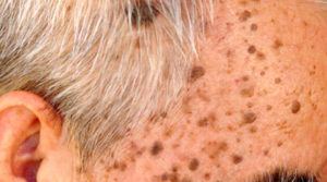 Seborrheic Keratosis Removal services in phoenix az by mobile skin screening home dermatologist angela