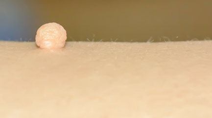 Skin tags are benign skin colored growths that are pedunculated (hanging from a stalk) pieces of skin that are often found where skin rubs together (i.e., underarms, neck and groin).