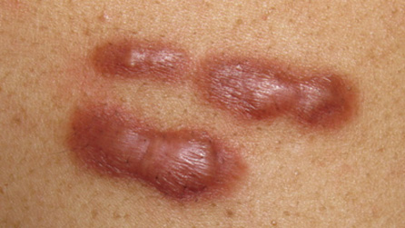 Affordable Keloid Treatment in phoenix arizona with mobile skin screening services