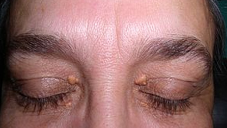 Xanthelasma removal Treatment services in phoenix az by mobile dermatologist MSS