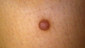 Dermatofibroma is a dome shaped bump found normally on the legs and arms that is caused by injury to the skin, such as an insect bite or an ingrown hair follicle. Dermatofibromas can appear skin colored, pink, reddish-brown, dark brown and black depending on skin complexion type.