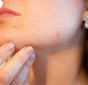 adult-acne-and-treating-other-skin-conditions-in-phoenix-az-with-mobile-services