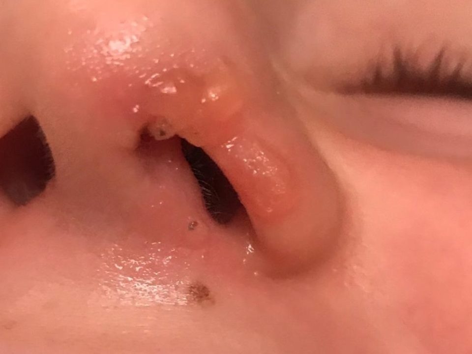 type of warts on face in metro phoenix, Arizona