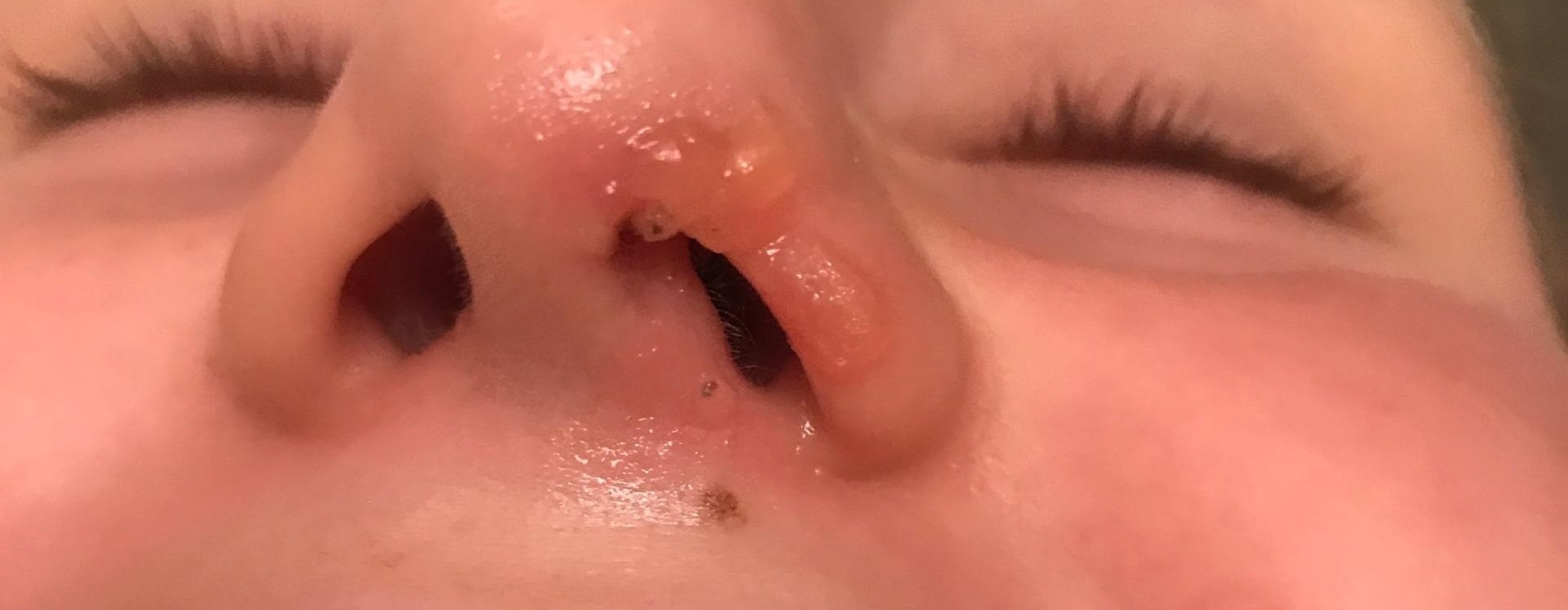 type of warts on face in metro phoenix, Arizona