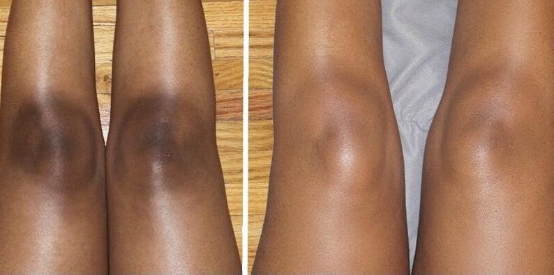 Legs Dark Spot Lightening Treatments in Metro Phoenix, Arizona