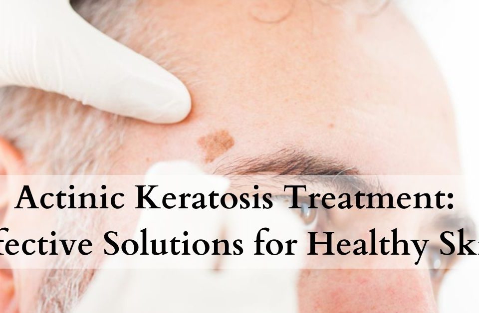 Actinic Keratosis Treatment Effective Solutions for Healthy Skin