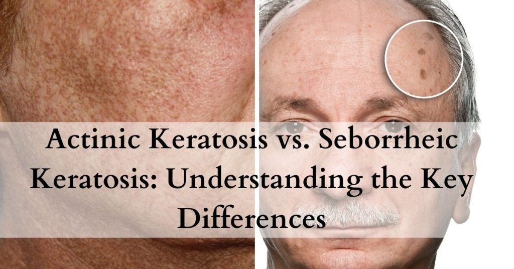 Actinic Keratosis vs Seborrheic Keratosis