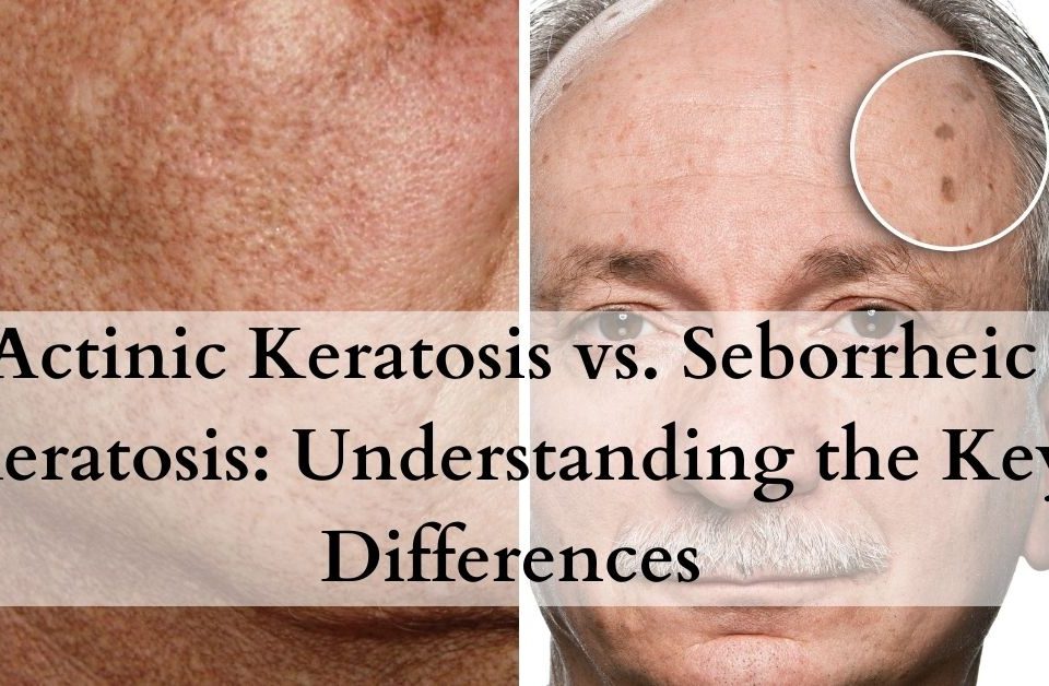 Actinic Keratosis vs. Seborrheic Keratosis Differences