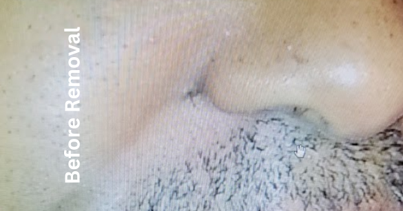 Mole Removal Treatment in Metro phoenix, Arizona
