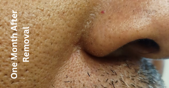 Before and After - Mole Removal Services in Phoenix Area, AZ
