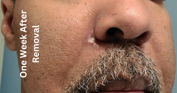 One Week After Removal - Mole Treatment in Metro Phoenix, Arizona