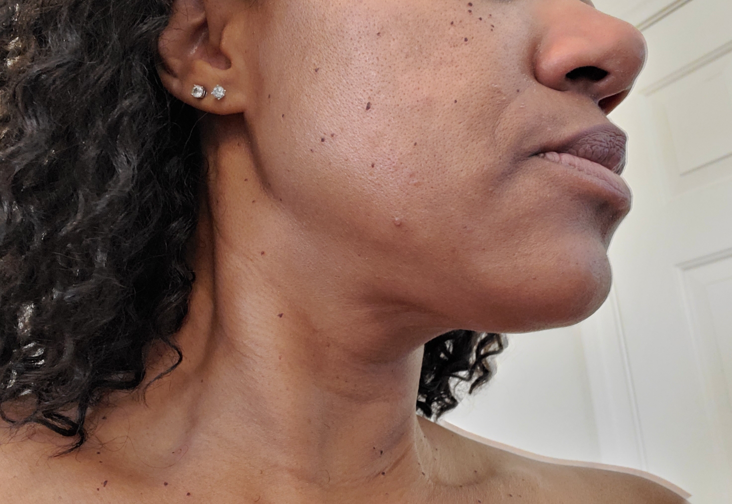 Dermatosis Papulosa Nigra (DPN) removal in Phoenix