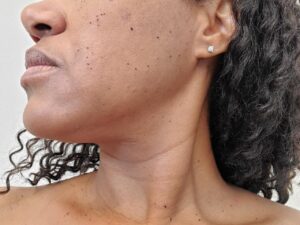 Dermatosis Papulosa Nigra (DPN) removal in Phoenix