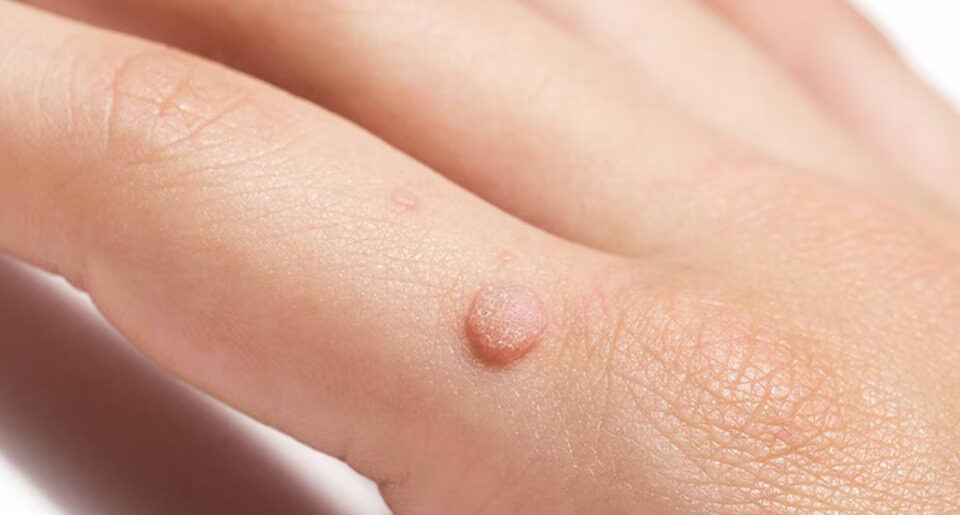 types of warts on fingers - metro phoenix, Arizona