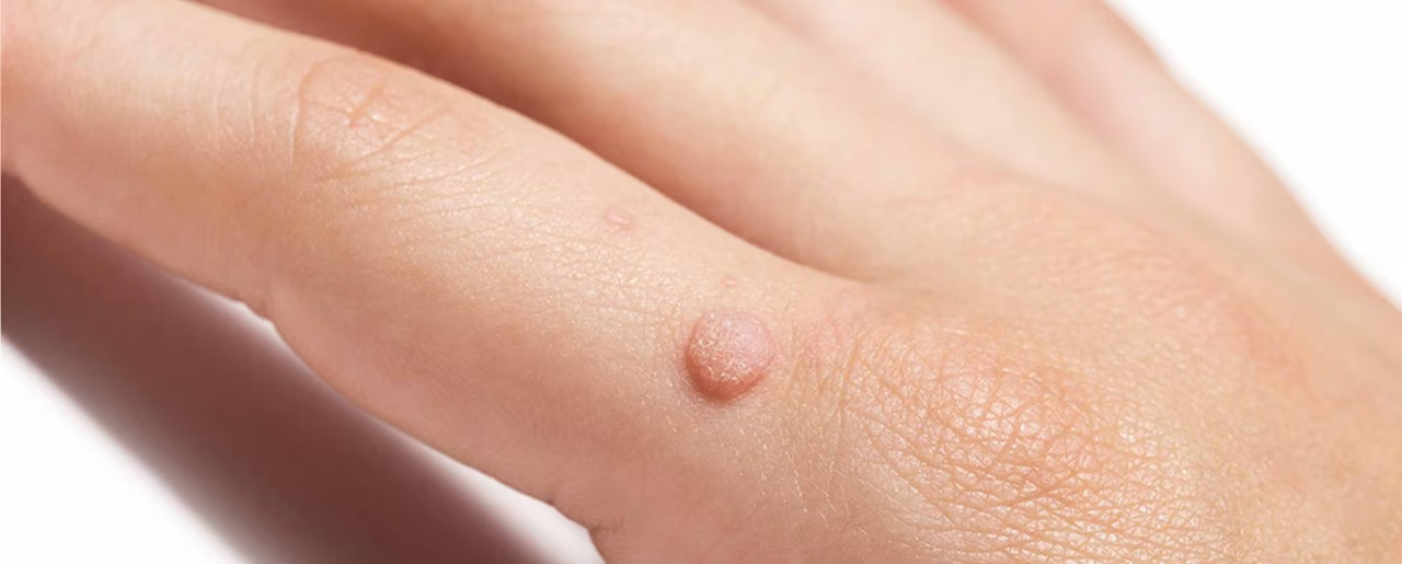 types of warts on fingers - metro phoenix, Arizona