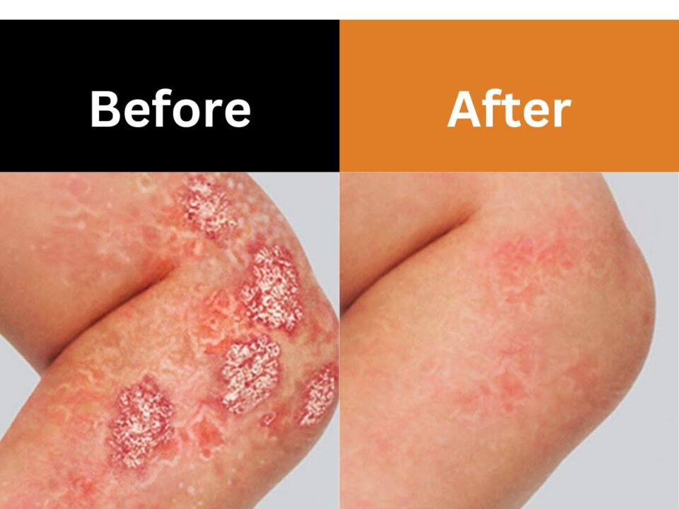 Psoriasis Treatment Metro Phoenix Arizona