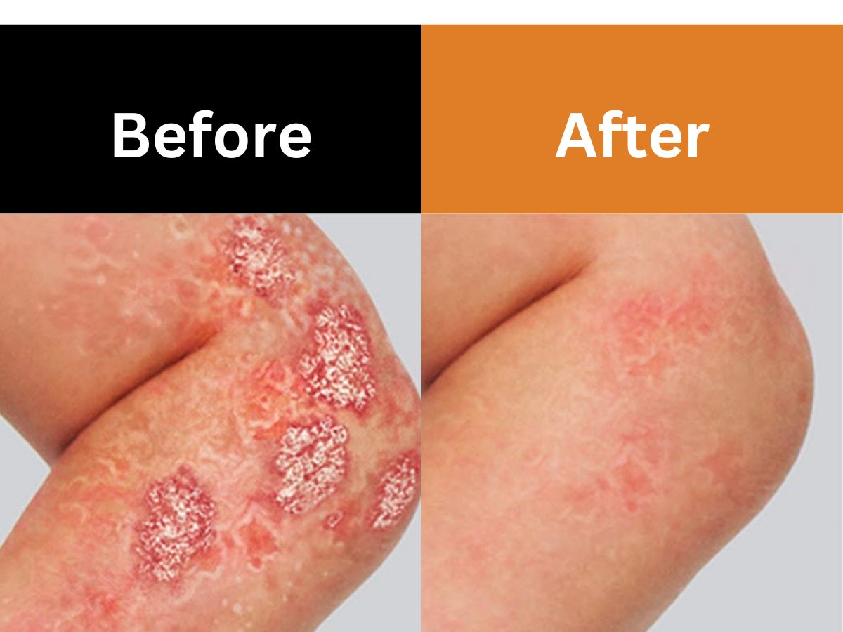 Psoriasis Treatment Metro Phoenix Arizona