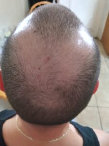 Hair Loss Treatment