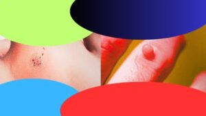 plantar wart vs corn wart - Mobile Skin Screening