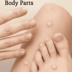 Can Plantar Warts on Fingers Spread to Other Body Parts